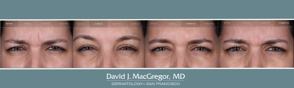 Everything You Need To Know About Daxxify Etre Vous